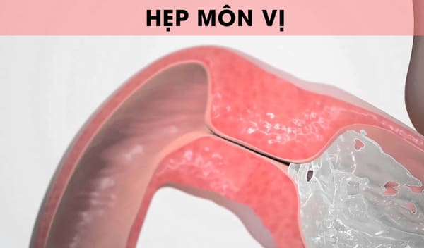 Hẹp môn vị là gì